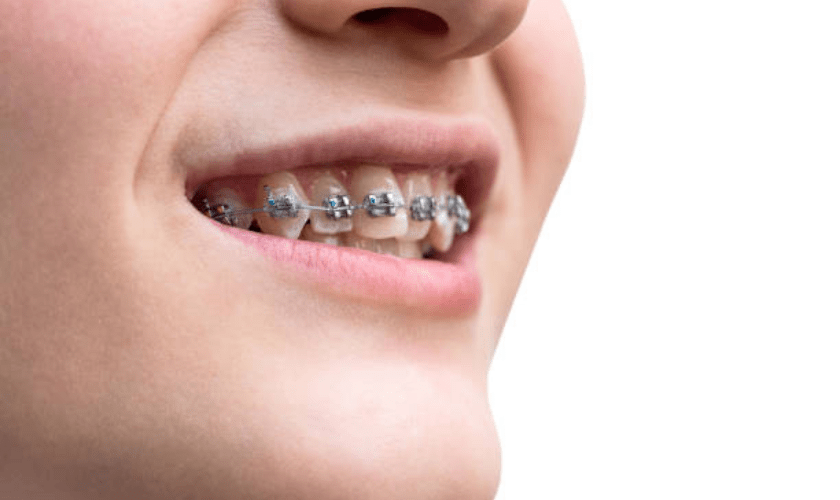 Braces: Definition, Benefits, Costs, Maintenance & Pain
