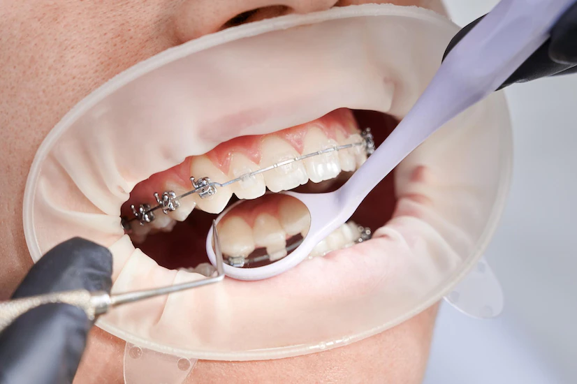 Fixed VS Removable Orthodontic Appliance: Which Is More Preferable?