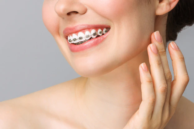 5 Things You Should Know About Taking Care Of Your Teeth With Braces On