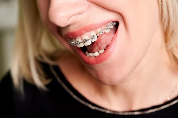 How Braces Can Correct Abnormal Tooth Eruption
