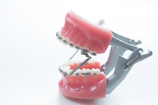 Bridge the gap: How orthodontic appliances can help replace missing teeth