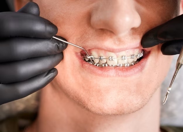 Getting Your Braces Off: What to Expect During the Process